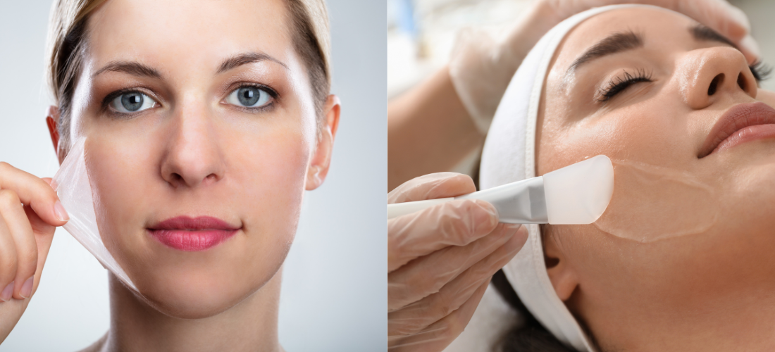 Chemical Peel Treatment